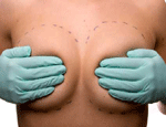 How much do breast implants cost?